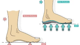 Orthotics in London, Ontario: The Ultimate Guide to Custom Foot